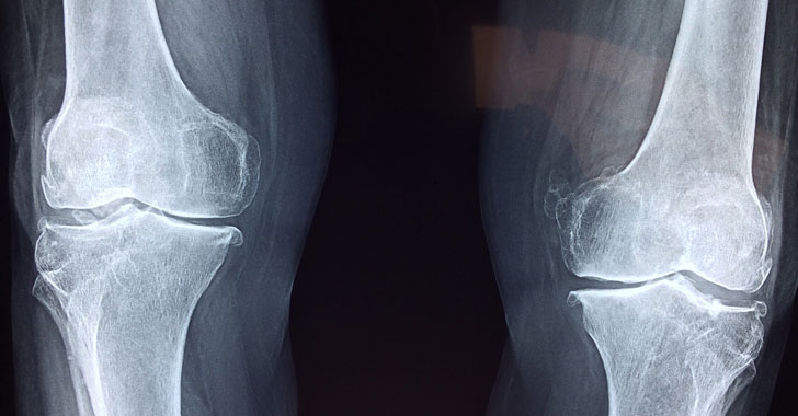 Hallan mutaciÃ³n que debilita los huesos con los fÃ¡rmacos para osteoporosis